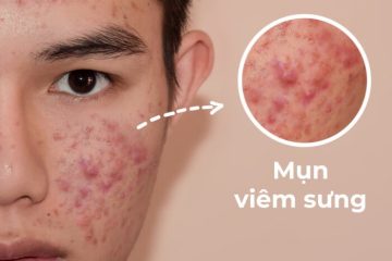 4 cách làm giảm mụn viêm sưng to đau nhức tại nhà hiệu quả nhất