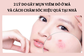 2 lý do gây mụn viêm đỏ ở má? Cách chăm sóc mụn viêm đơn giản, hiệu quả bác sĩ da liễu khuyến cáo