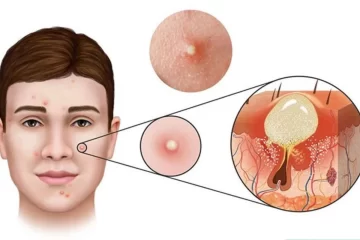 3 lý do không nên tự nặn mụn viêm tại nhà bạn nên biết