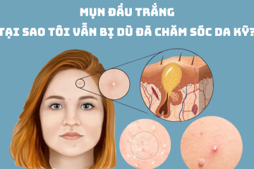 Mụn đầu trắng: Tại sao tôi vẫn bị dù đã chăm sóc da kỹ?