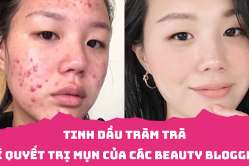 Bí quyết trị mụn của các beauty blogger: Tinh dầu tràm trà