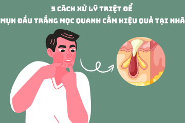 5 cách xử lý triệt để mụn đầu trắng mọc quanh cằm hiệu quả tại nhà