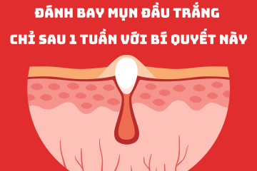 Đánh bay mụn đầu trắng chỉ sau 1 tuần với bí quyết này