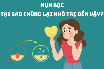 Mụn bọc: Tại sao chúng lại khó trị đến vậy?