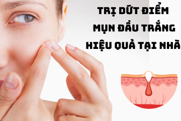 Mụn đầu trắng: Đừng lo lắng, đã có cách trị dứt điểm tại nhà