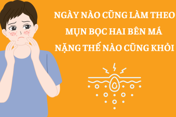 Ngày nào cũng làm theo, mụn bọc hai bên má nặng thế nào cũng khỏi