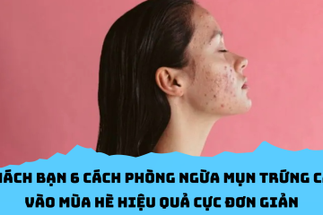 Mách bạn 6 cách phòng ngừa mụn trứng cá vào mùa hè hiệu quả cực đơn giản