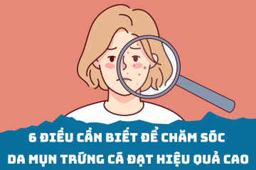 6 điều cần biết để chăm sóc da mụn trứng cá đạt hiệu quả cao