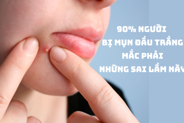 90% người bị mụn đầu trắng mắc phải những sai lầm này
