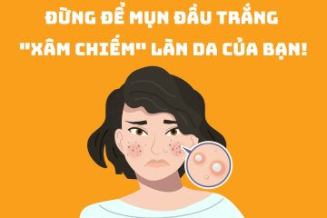Đừng để mụn đầu trắng “xâm chiếm” làn da của bạn!