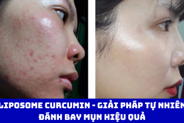 Liposome Curcumin – Giải pháp tự nhiên đánh bay mụn hiệu quả